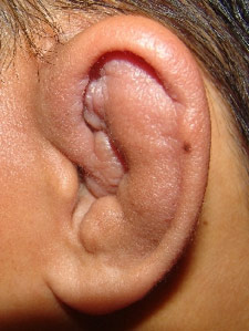 cauliflower-ear