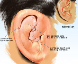 Read more about the article What is Cauliflower Ear?