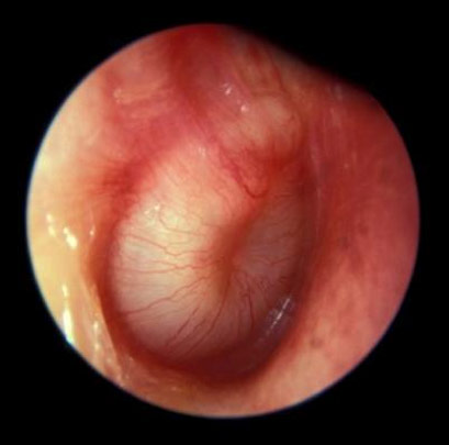 The white appearance of the ear drum suggests there is infected fluid in the middle ear.