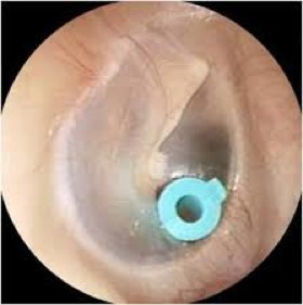 Ear tube in place creating a connection between the middle ear and the ear canal.