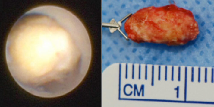 Figure: Left: A stone visualized in a salivary duct using sialendoscopy.              Right: Salivary stone after removal. 