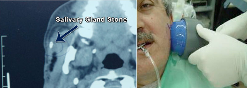 Figure: Left - CT scan of the head with a visible stone in the right parotid salivary gland. Right – Lithotripsy patient undergoing procedure.