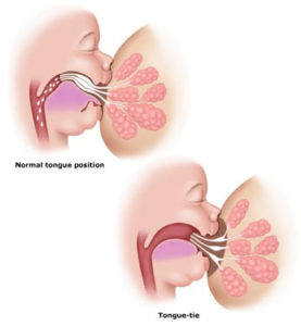 Read more about the article What is Tongue Tie and How Does it Affect Children?