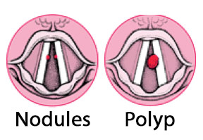 Read more about the article Vocal Fold Nodules