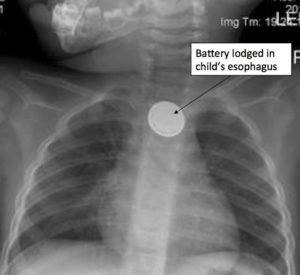 Read more about the article Why Button Batteries are Dangerous for Children