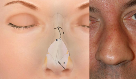 Figure 2: After a nasal trauma it is common to have fracture of the nasal bones (a), fracture of the septum (b) and tearing of nasal cartilages (c).