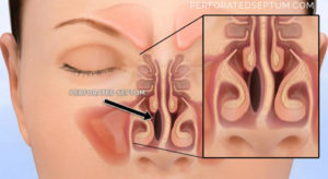 Read more about the article Rhinoplasty and Septal Perforation Repair