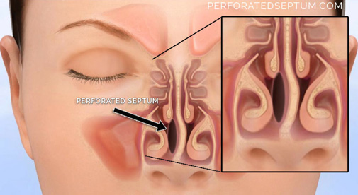 Figure 2: Frontal view of the nasal passages depicting a septal perforation.
