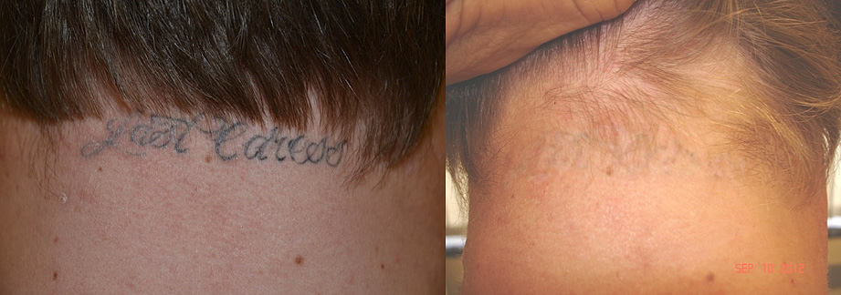 Figure 2a: Original tattoo on the back of the neck. Figure 2b: After saline method tattoo removal. 