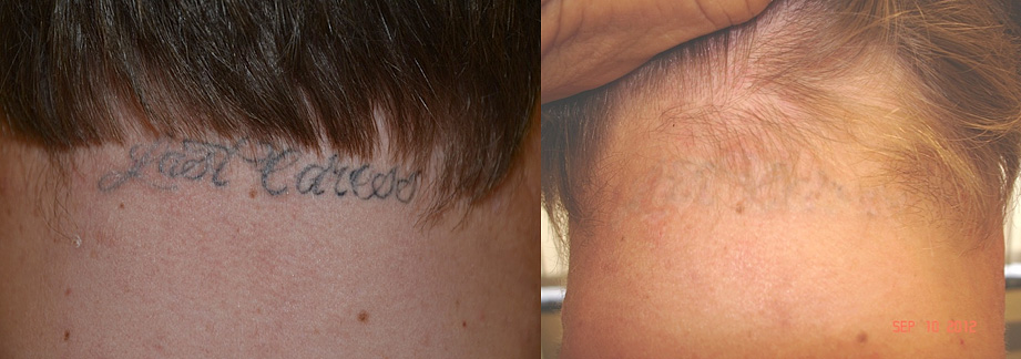 VIDEO Laser Tattoo Removal Los Angeles Patient Video Results  Dr U Hair   Skin Clinic  FUE Hair Restoration Dermatology and Laser Surgery  Los  Angeles Manhattan Beach  Dr Sanusi Umar MD