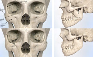Read more about the article Cheekbone Fracture/ Zygoma Treatment Options