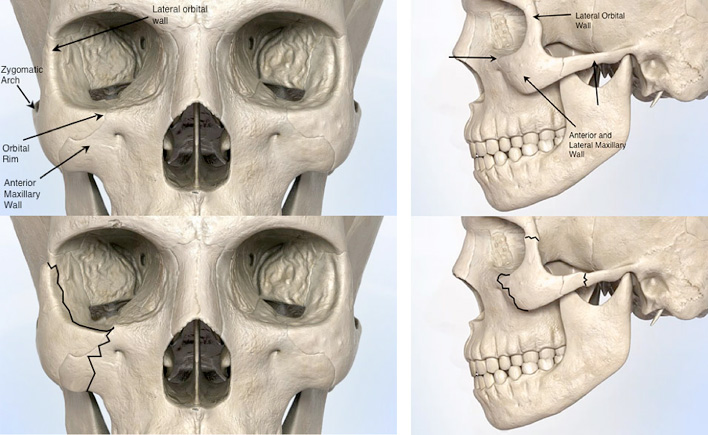 Figure 1: Schematic of structures comprising the cheekbone area (top). Areas commonly fractured during a cheekbone fracture (bottom).