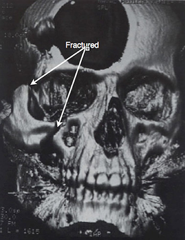 Figure 2: 3D CT reconstruction of the head depicting a cheekbone fracture.