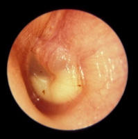 Examination of ear drum showing otitis media (ear infection)