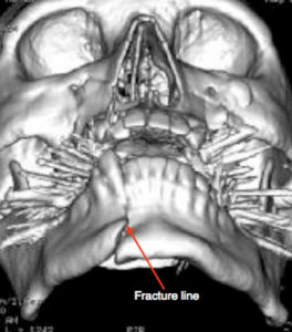 Read more about the article Mandibular Fracture and Treatment