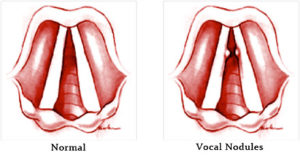 Read more about the article Vocal Nodules: Diagnosis