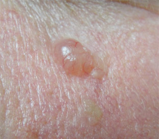 basal-cell-carcinoma