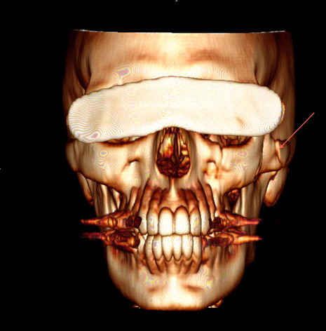 Figure 1: 3D-CT Reconstruction with cheekbone fracture denoted by the arrow.