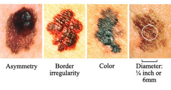 Source: NCI Visuals Online. Skin Cancer Foundation