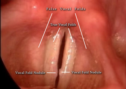 Figure 2: High-resolution video stroboscopy image depicting two vocal cord nodules.