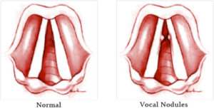 Read more about the article Vocal Strain – Muscle Tension Dysphonia