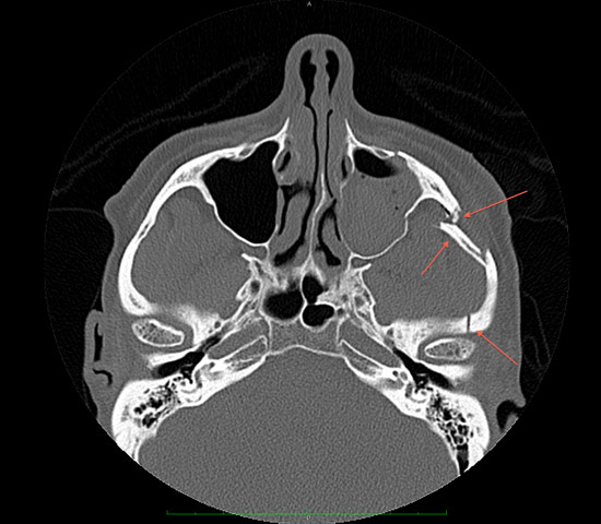 Figure 2: CT image of the head demonstrating cheekbone fracture with displacement of the resulting bone fracture. This fracture resulted from golf club trauma.