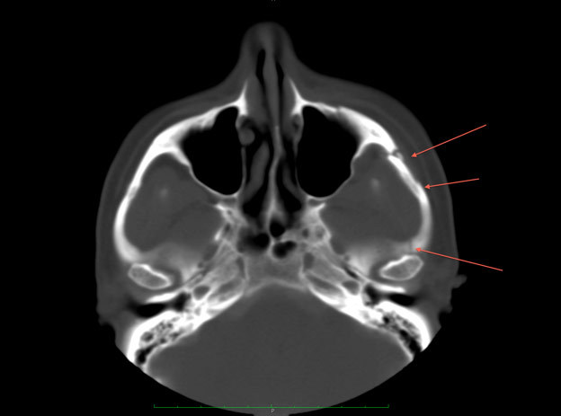 Figure 3: CT image of the same patient after cheekbone fracture repair.