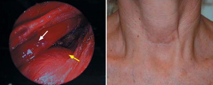 Figure 2. Left: Endoscopic view of a large thyroid mass (yellow) Right: Four-month postoperative endoscopic thyroidectomy scar.