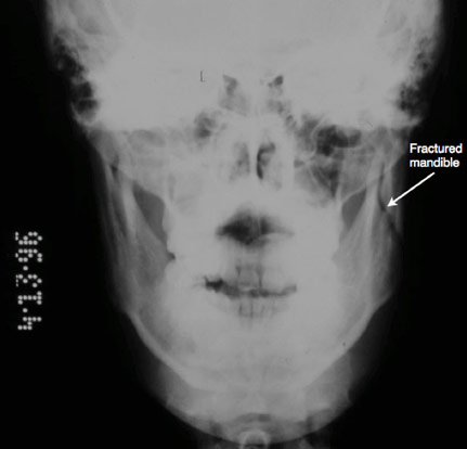 Figure 2: X-ray of the head depicting a mandibular fracture.