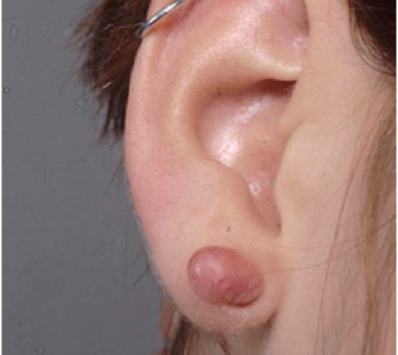 Figure 2: A keloid located on the ear lobe that resulted from a routine ear piercing.