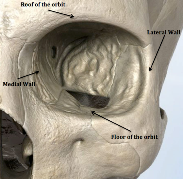 Figure 1. Illustration depicting the left bony orbit. The circular orbit is divided into four walls. Fractures involving the orbit most commonly affect the orbital floor (inferior wall). 