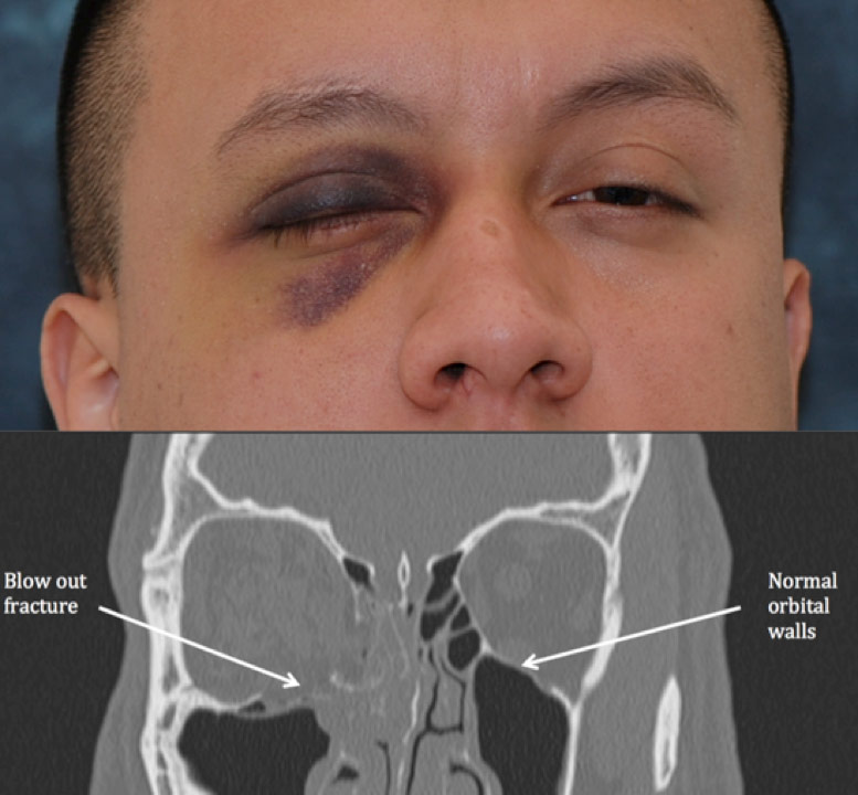 Figure 2a,2b. An example of a patient presenting with a right orbital floor blowout fracture. Bruising and limited eye movements secondary to swelling are common clinical presentations (top). CT scan demonstrates common findings of a blow out fracture with evidence of a depressed right orbital floor (bottom).