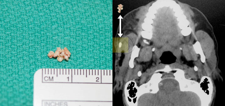 Figure 1. Salivary gland stones counted and measured for display after removal from the ductal system via a sialendoscopy procedure performed at the Osborne Head and Neck Institute. After salivary stones are removed they are correlated with stones visualized on a preoperative CT scan.