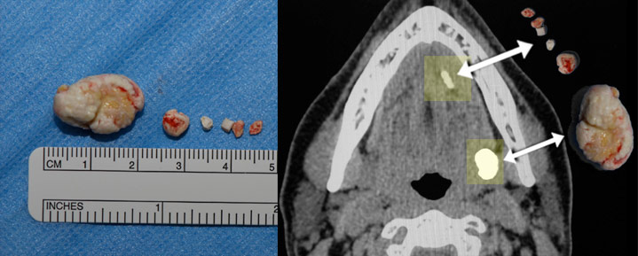 Figure 1. Salivary gland stones counted and measured for display after removal from the ductal system via a sialendoscopy procedure performed at the Osborne Head and Neck Institute. After salivary stones are removed they are correlated with stones visualized on a preoperative CT scan.