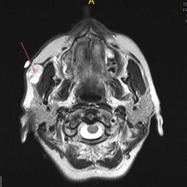 Figure 2: T2 weighted axial MRI of the head demonstrating a right accessory parotid gland tumor (arrow).