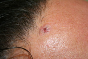Read more about the article Basal Cell Carcinoma