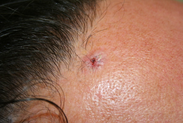 Figure 1: Basal cell carcinoma seen with characteristic shiny pearl-like appearance with area of central ulceration. This lesion was located on the patients forehead.