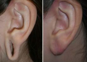 Read more about the article Earlobe Recovery After Gauge Piercings