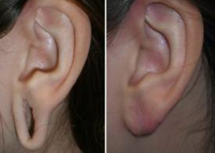 Figure 1: A picture of an earlobe that has been stretched by gauge piercings (left). The patients ear after undergoing surgical reconstruction (right).