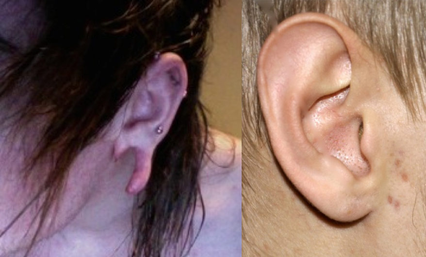 Figure 2: Example of a torn earlobe (left). A patient that has undergone successful surgical reconstruction with full recovery (right).