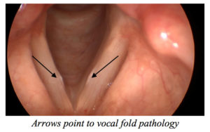 Read more about the article Voice Case of the Week: A Hoarse Singer