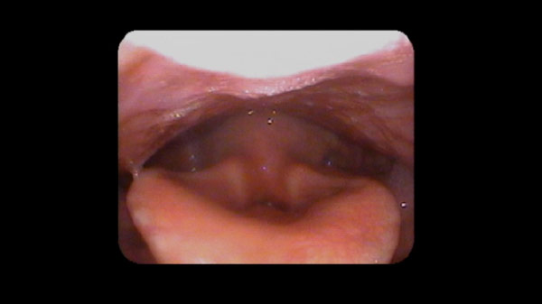 Figure 1: Freeze frame showing significant compression of muscles around the vocal folds, resulting in obliteration of the view of the folds.