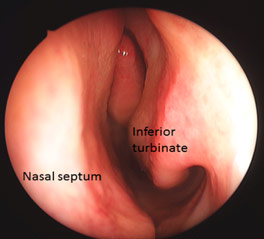 Figure 1: Nasoendoscopic view of the left nasal passage. A normal inferior turbinate is visible.