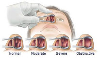 What Is Turbinate Hypertrophy And How Does It Cause Nasal Congestion What Is Turbinate Hypertrophy And How Does It Cause Nasal Congestion