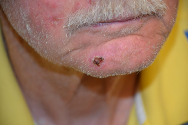 Figure 1: Patient with squamous cell carcinoma lesion on the chin. Note the characteristic large, red, crusty, and scaly appearance of the lesion.