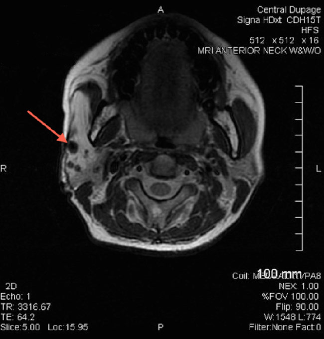Figure 1: Axial MRI of the head demonstrating an arteriovenous malformation (arrow). 