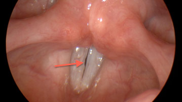 Figure 1: Stroboscopy image of the vocal folds demonstrating incomplete closure.