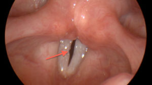 Read more about the article Voice Case of the Week: Vocal Folds in a Gospel Singer