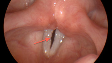 Figure 2: Stroboscopy image of the vocal cords demonstrating formation of vocal fold scarring/sulcus vocalis.
