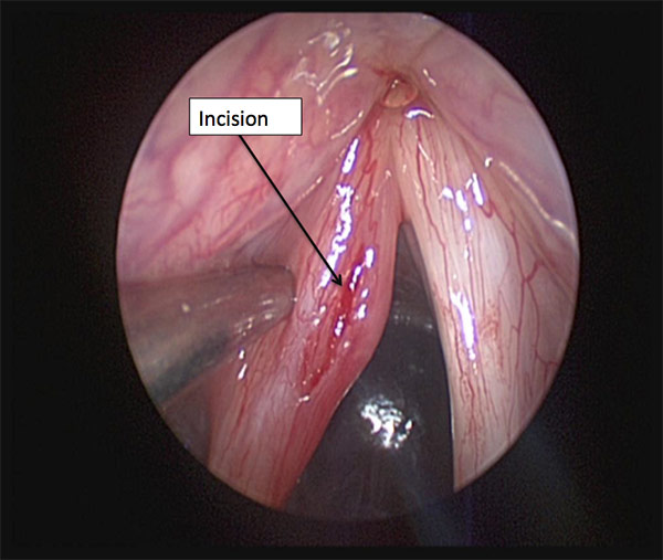 Figure 1: An incision was made in the vocal fold lateral to the apparent mass.